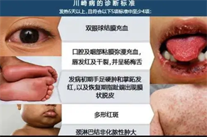 3川崎病典型症状.png